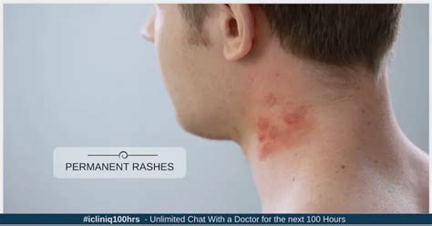 I Am Having Permanent Rashes On The Sides Of My Neck What Are They