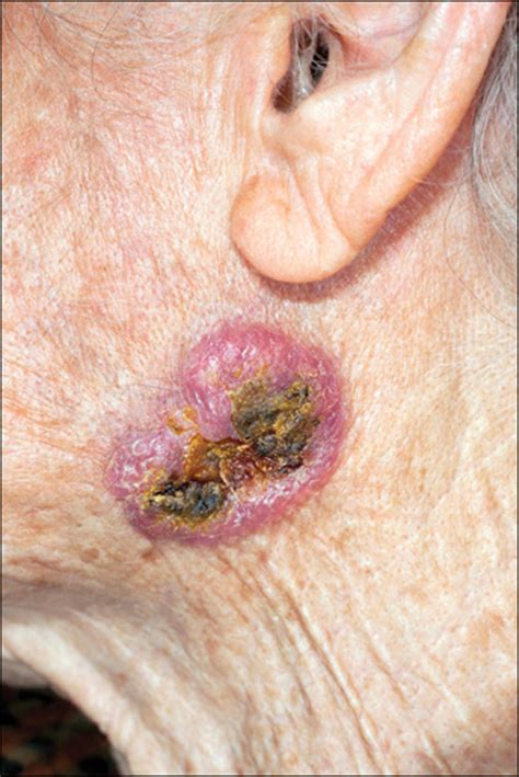 Systemic Therapy For Advanced Basal Cell Carcinoma The Lancet Oncology