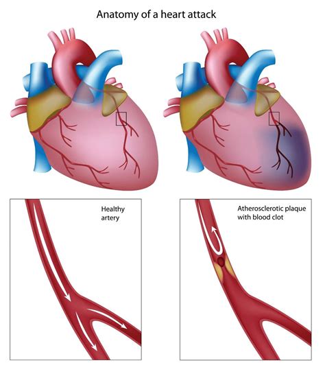 Myocardial Infarction The Heart And Diving Dan Health And Diving