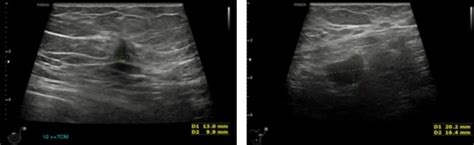 Cureus Breast Apocrine Carcinoma Detected Incidentally As Axillary