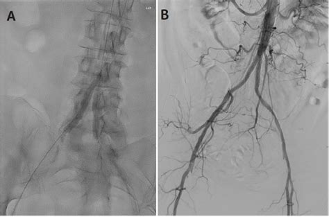 Use Of Intravascular Lithotripsy For Severe Calcification In