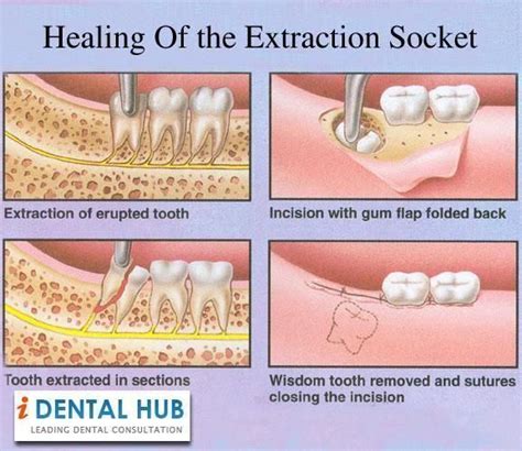 Unadvised Tooth Extraction Root Canal DentistadelasEstrellas