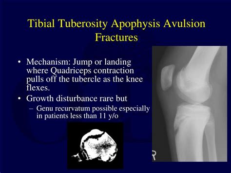 Distal Tibial Tuberosity