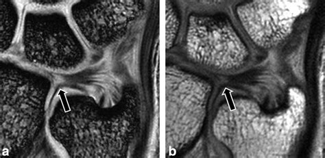Mr Imaging Of The Traumatic Triangular Fibrocartilaginous Complex Tear