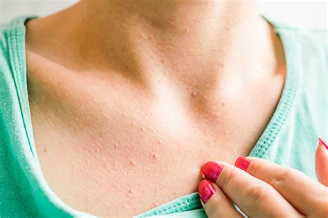 Clogged Pores On Breasts Why Do We Have It And How To Prevent — Aeno