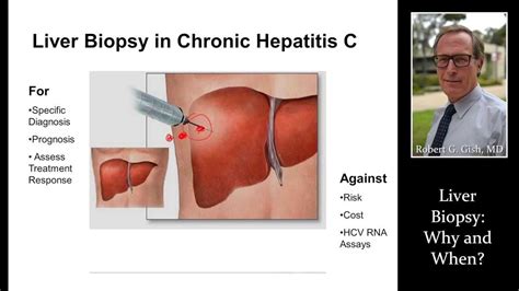 LIVER BIOPSY by Dr. Robert Gish - YouTube