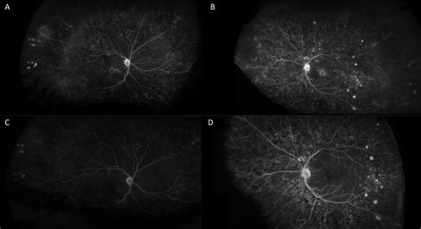 Siponimod Related Bilateral Cystoid Macular Oedema And Intravenous