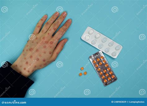 Hand With Blistering Rash And Medicines Stock Image Image Of