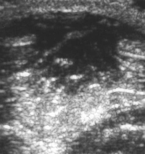 Sonography Of Muscle Hernias Ajr