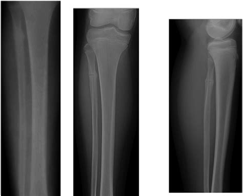 Proximal Fibular Stress Fractures In Children And Adolescents What