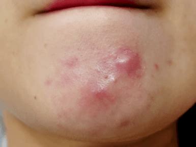 Below, they share what cystic acne is, what causes it, and—what we've all been waiting for—the best cystic acne treatments. Cystic Acne - How is it caused and how can you treat it?