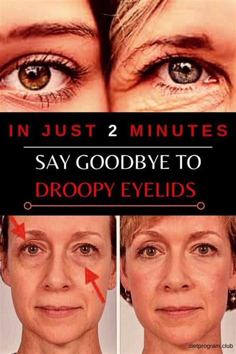 Solve Your Drooping Eyelids Problem Naturally In 2 Minutes Diet
