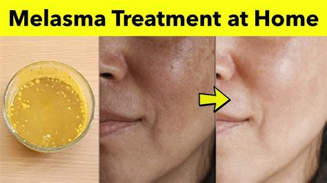 How To Get Rid Of Melasma On Face 3 Natural Home Remedies For