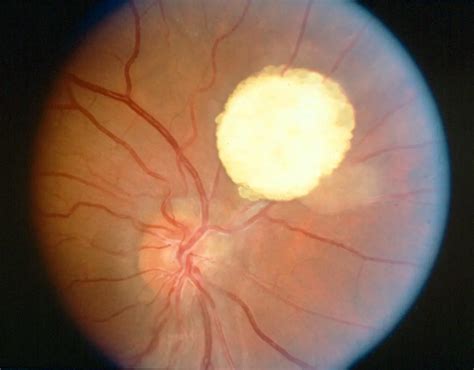 Tuberous Sclerosis Retina American Academy Of Ophthalmology