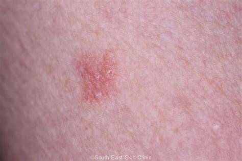 Symptoms Of Skin Cancer On Upper Leg Cancerwalls