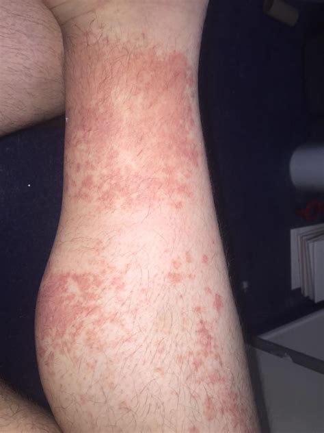 Just Found Out I Have A 6th Allergy Today Say Hello Too My Wool Rash 😂