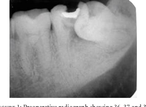 Figure 1 From Autotransplantation Of Mandibular Third Molar A Case