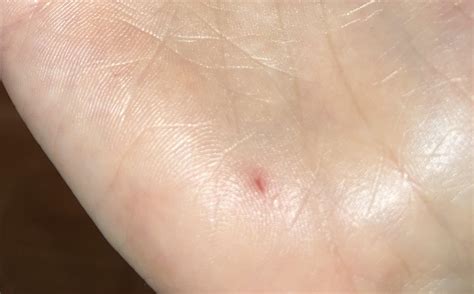 Hole In My Hand That Ive Had For Decades And Wont Close Up What Is