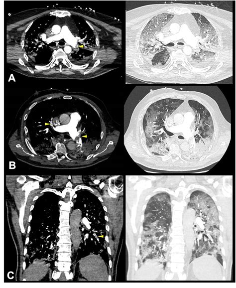 Pulmonary embolism or thrombosis in ARDS COVID-19 patients ...
