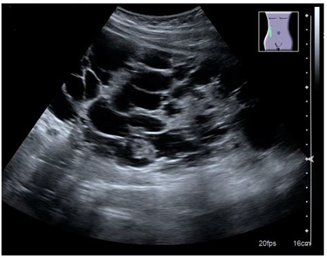 Infantile Polycystic Kidney Disease Ultrasound