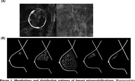 Pdf Microcalcifications In Breast Cancer From Pathophysiology To