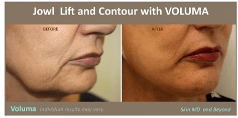 Facial Fillers Plano Tx Dermal Fillers And Anti Wrinkle