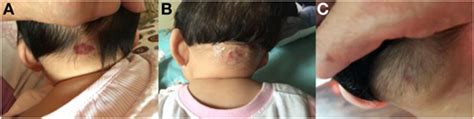 Frontiers Topical Application Of 05 Timolol Maleate Hydrogel For The Treatment Of
