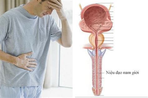 Viêm niệu đạo ở nữ là tình trạng niệu đạo (hoặc ống dẫn nước tiểu từ bàng quang ra ngoài cơ thể) bị viêm hoặc kích ứng, nguyên nhân chính là do nhiễm khuẩn. Bệnh hẹp niệu đạo ở nam giới chớ coi thường? Vì sao? - Icondom