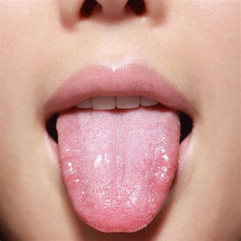 White Spots On Tongue - White Spots on Tongue, Bumps, Patches, Painful