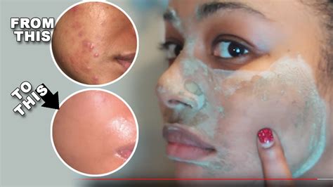 The Best Deep Pore Cleansing Face Mask For Acne Prone Skin Aztec