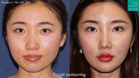 Asian Skin San Diego Ca Cosmetic Laser Dermatology