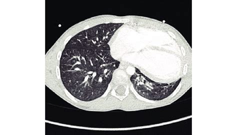 Contrast Enhanced Thoracic Computed Tomography In Axial View Showing