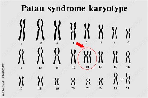 Patau Syndrome Karyotype Is The One Of Chromosomal Disorders That Have