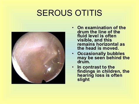 Otitis Part 3