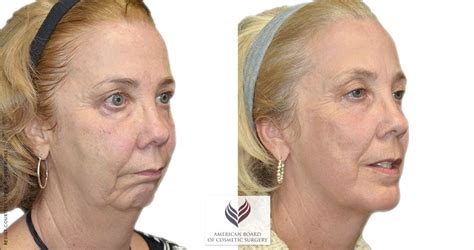 What Is Facelift Surgery Nashville Tn Cosmetic Surgery Neck Lift