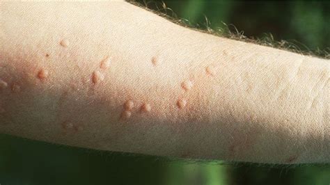 How To Describe Insect Bites Dermatology