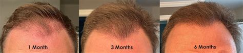 6 Month Hair Transplant Transition Hair Restoration Center Of Ct