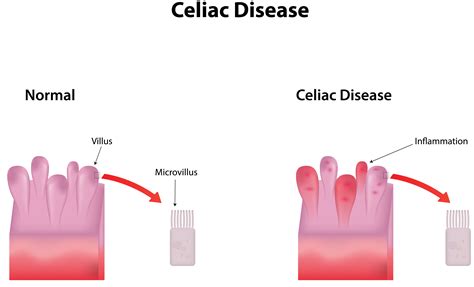 Celiac Disease Jackson Siegelbaum Gastroenterology