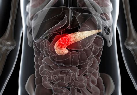 Best Practices To Screen For Pancreatic Cancer In High