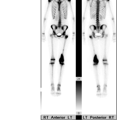 Whole Body Technetium Bone Scan Of The Patient In Fig 5 Demonstrating