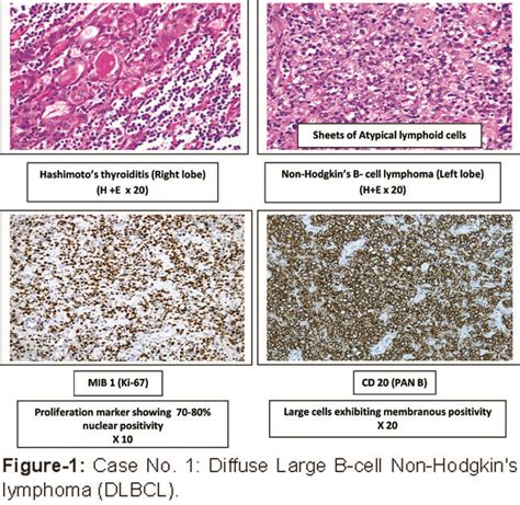 Both forms of lymphoma are relatively rare, and populations affected by the diseases vary. JPMA - Journal Of Pakistan Medical Association