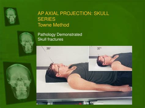 Ppt Positioning Of The Skull Powerpoint Presentation Free Download