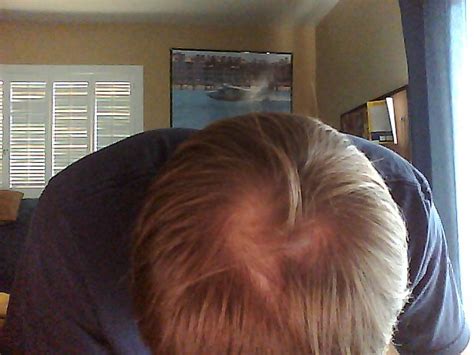 I am asian so i know our hair follicals are more coarse but more spread out. Finasteride Blog: Day 23 vs. Day 50