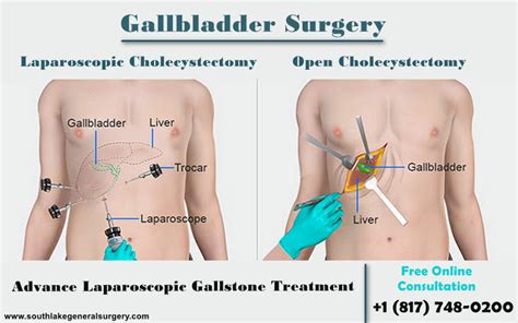 5 Signs That You Should Need Gallbladder Surgery Southlake General