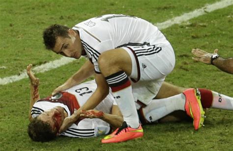 23 Injury Photos That Prove Soccer Is Not For The Weak