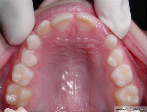 Morphology Of Deciduous Teeth Pptx دعمر Muhadharaty
