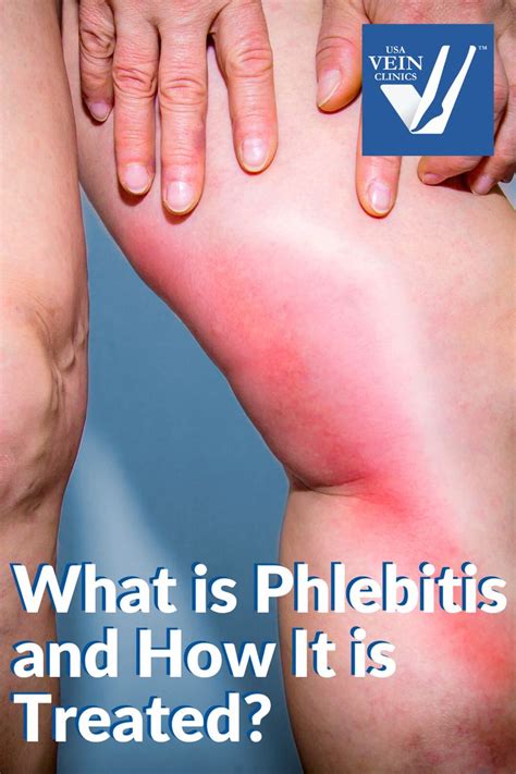 What Is Phlebitis And How Is It Treated Usa Vein Clinics Vein