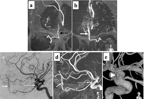 Digital Subtraction Angiography Dsa Of Internal Carotid Artery Ica