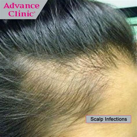 Scalp Infections Ringworm Which Is A Very Common Fungal Scalp Infection Causes Bulk Hair Loss