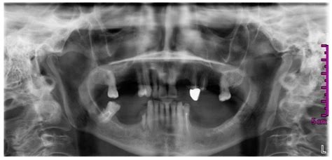 Dentistry Journal Free Full Text Osteonecrosis Of The Jaw Onj In